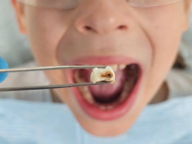 Best Emergency Wisdom Teeth Removal in Garrett, IN